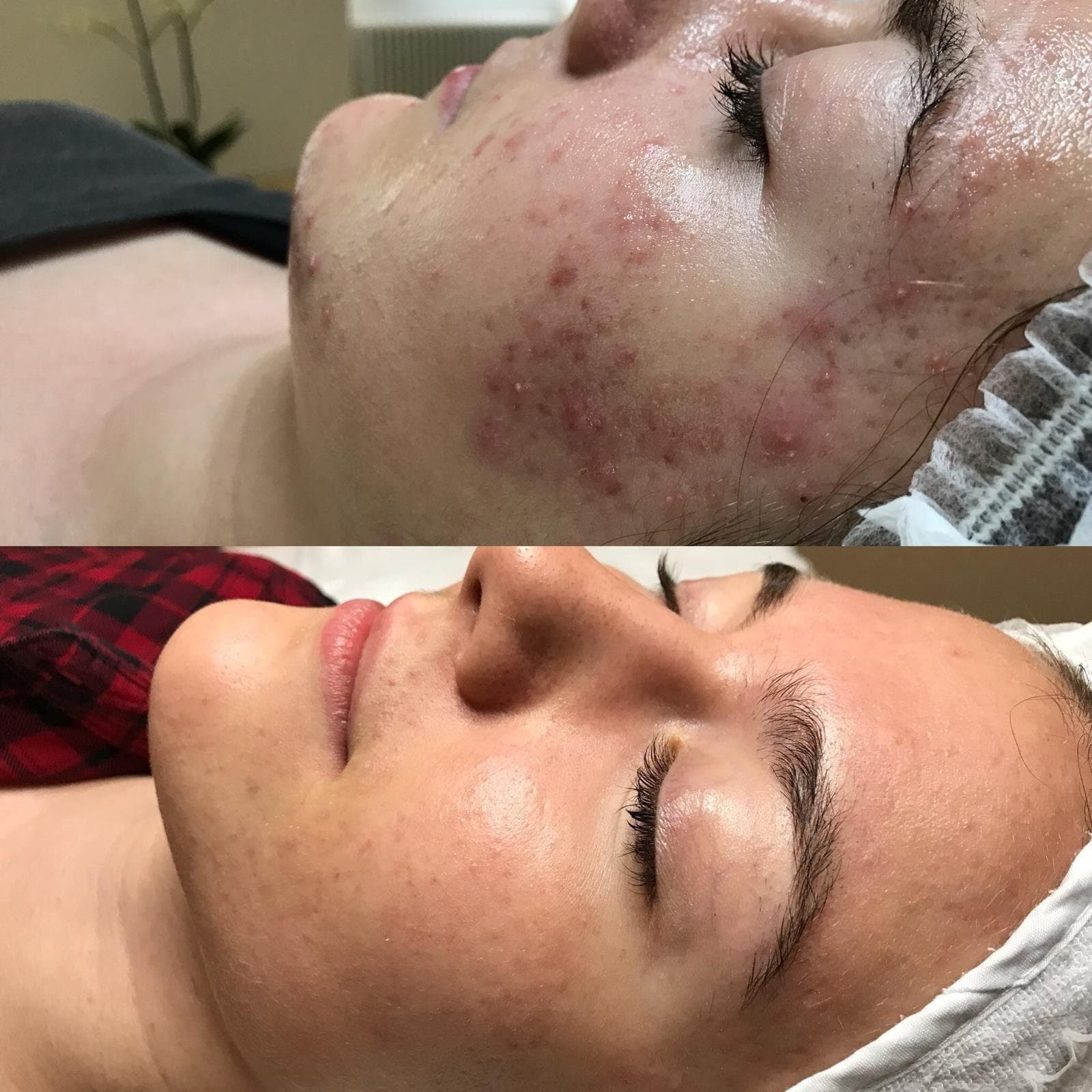 Problemhaut Resultat bei Eve’s Beauty Lounge
