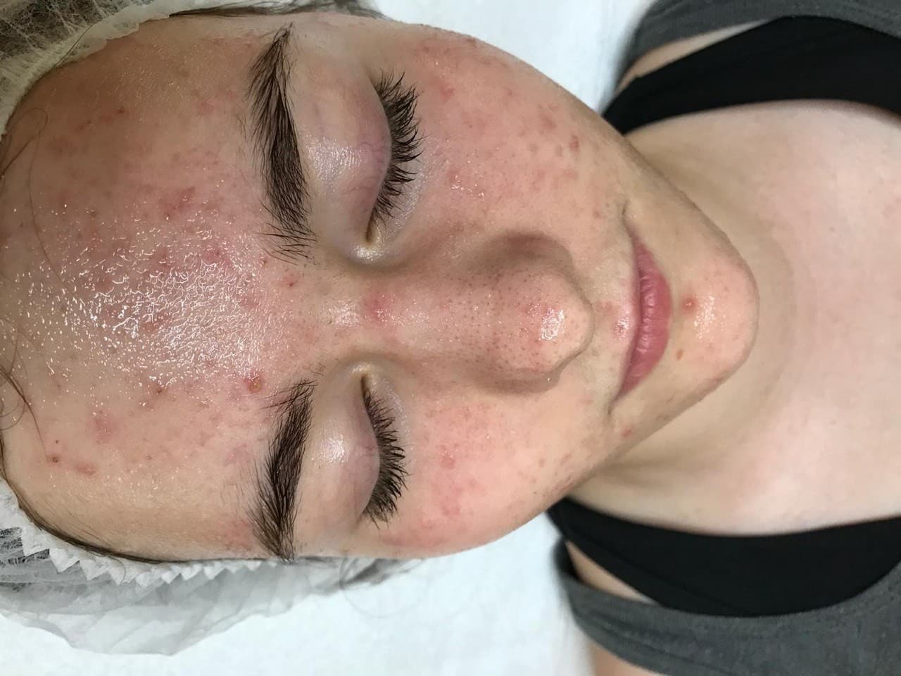 Teenager-Akne Behandlung bei Eve’s Beauty Lounge